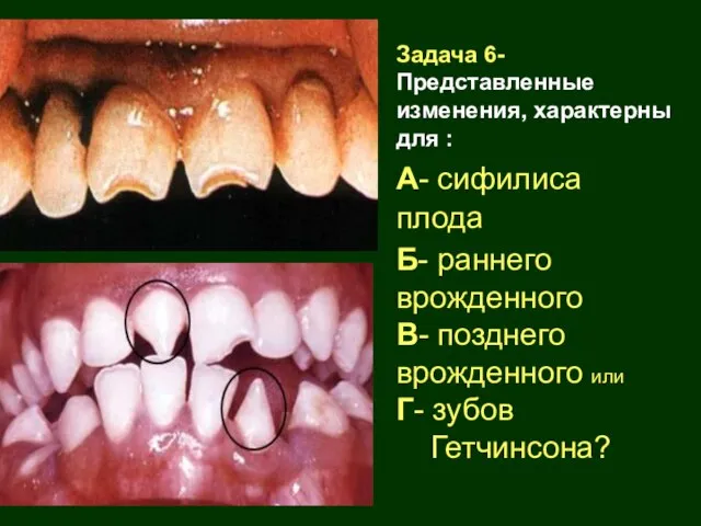 Задача 6- Представленные изменения, характерны для : А- сифилиса плода Б- раннего