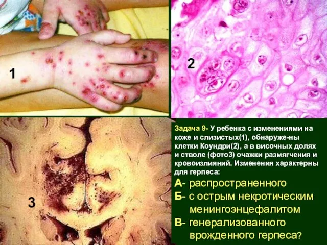 Задача 9- У ребенка с изменениями на коже и слизистых(1), обнаруже-ны клетки