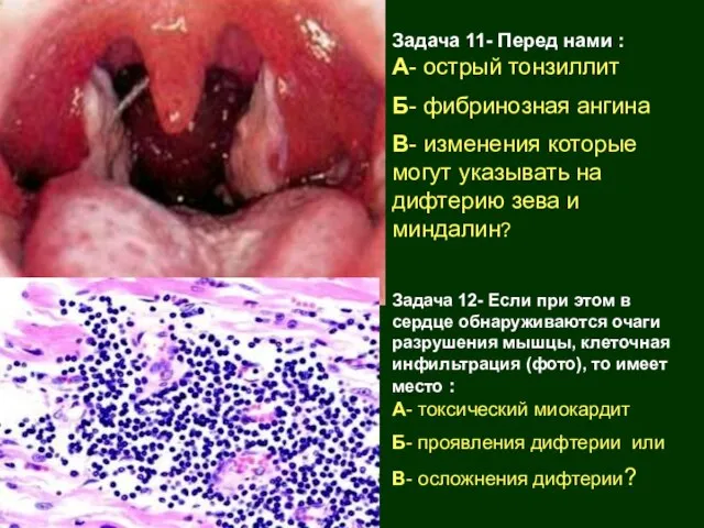 Задача 11- Перед нами : А- острый тонзиллит Б- фибринозная ангина В-