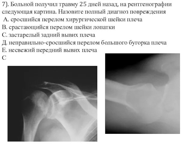 7). Больной получил травму 25 дней назад, на рентгенографии следующая картина. Назовите