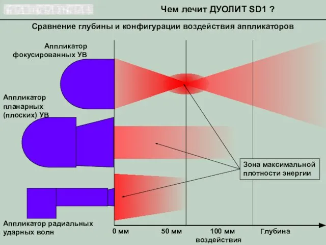 Сравнение глубины и конфигурации воздействия аппликаторов Чем лечит ДУОЛИТ SD1 ? 0