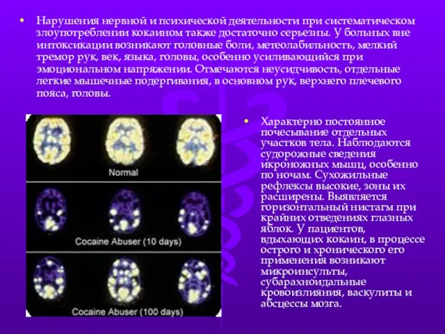 Нарушения нервной и психической деятельности при систематическом злоупотреблении кокаином также достаточно серьезны.