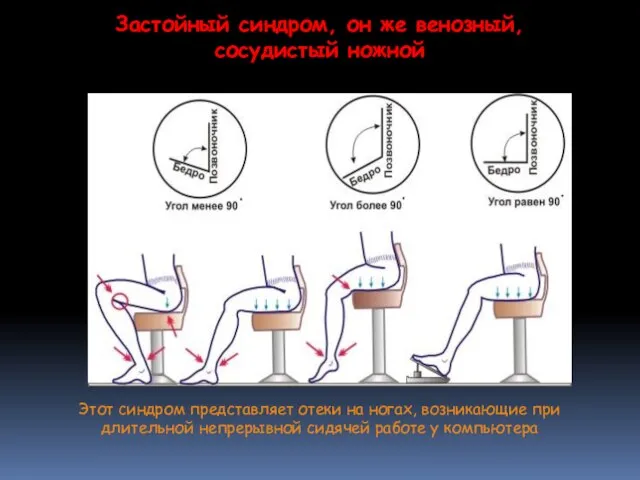 Этот синдром представляет отеки на ногах, возникающие при длительной непрерывной сидячей работе