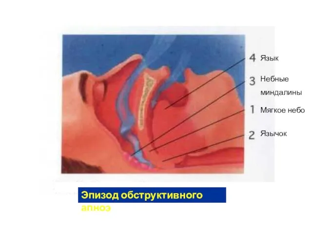 Эпизод обструктивного апноэ Мягкое небо Язычок Небные миндалины Язык