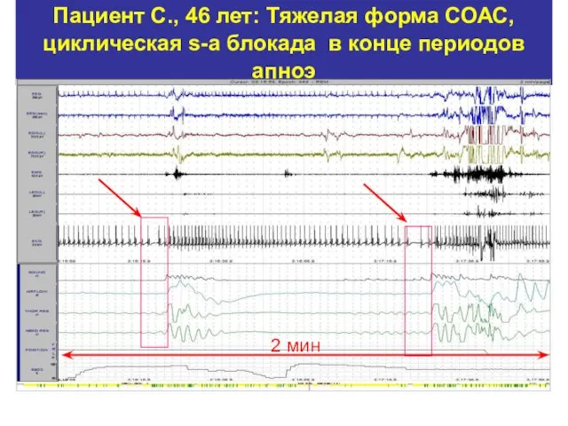 Пациент С., 46 лет: Тяжелая форма СОАС, циклическая s-a блокада в конце периодов апноэ 2 мин