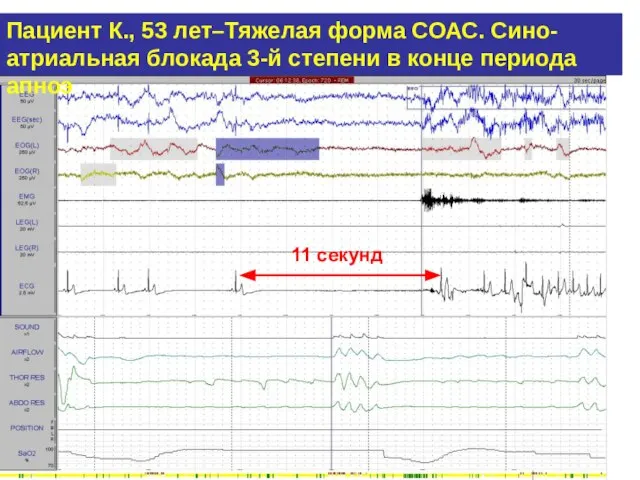 Пациент К., 53 лет–Тяжелая форма СОАС. Сино-атриальная блокада 3-й степени в конце периода апноэ 11 секунд