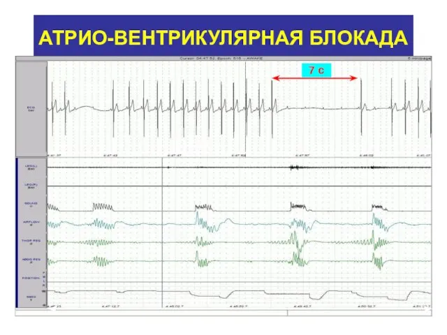 АТРИО-ВЕНТРИКУЛЯРНАЯ БЛОКАДА 5 мин 30 сек 7 c
