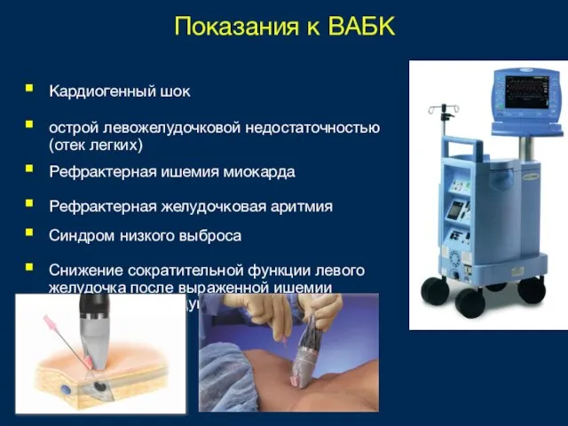 Показания к ВАБК Кардиогенный шок острой левожелудочковой недостаточностью (отек легких) Рефрактерная ишемия