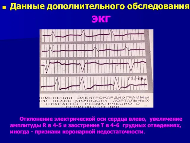 Данные дополнительного обследования. экг Отклонение электрической оси сердца влево, увеличение амплитуды R