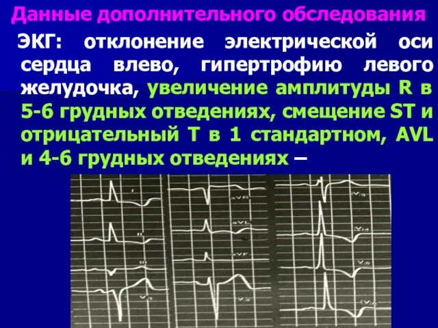 Данные дополнительного обследования ЭКГ: отклонение электрической оси сердца влево, гипертрофию левого желудочка,