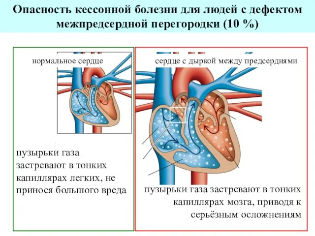 Опасность кессонной болезни для людей с дефектом межпредсердной перегородки (10 %) нормальное