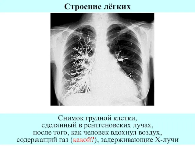 Снимок грудной клетки, сделанный в рентгеновских лучах, после того, как человек вдохнул
