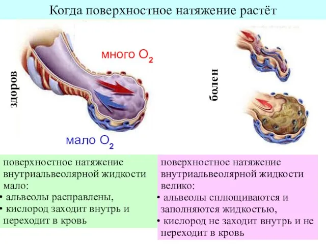 Когда поверхностное натяжение растёт поверхностное натяжение внутриальвеолярной жидкости мало: альвеолы расправлены, кислород