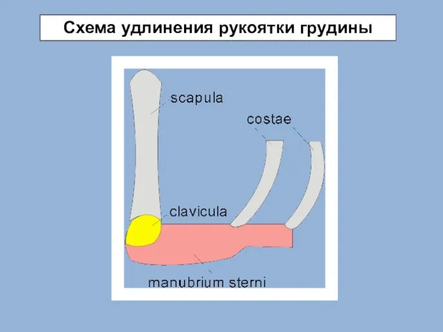 Схема удлинения рукоятки грудины