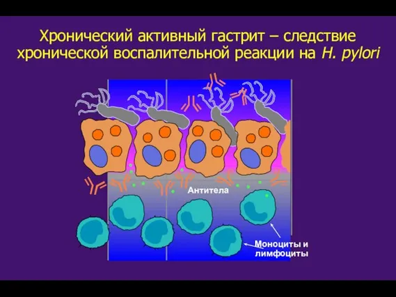 Антитела Моноциты и лимфоциты Хронический активный гастрит – следствие хронической воспалительной реакции на H. pylori