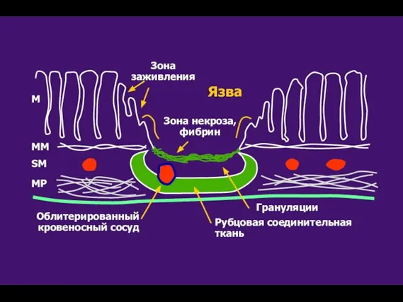 Облитерированный кровеносный сосуд Рубцовая соединительная ткань Грануляции Зона заживления Язва Зона некроза,