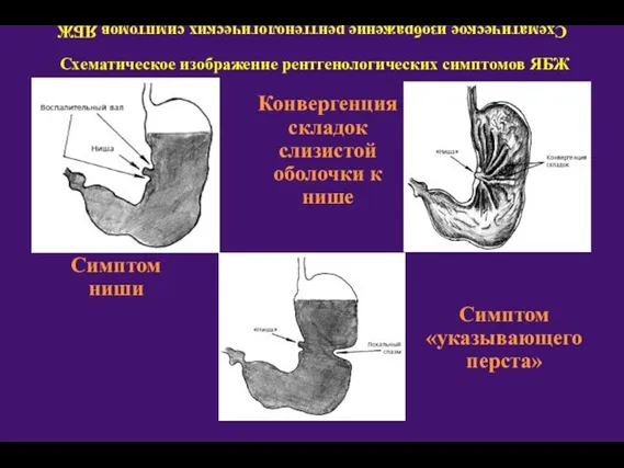 Схематическое изображение рентгенологических симптомов ЯБЖ Схематическое изображение рентгенологических симптомов ЯБЖ Симптом ниши