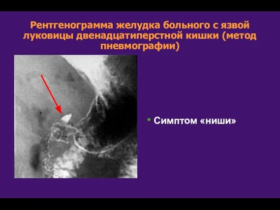 Рентгенограмма желудка больного с язвой луковицы двенадцатиперстной кишки (метод пневмографии) Симптом «ниши»