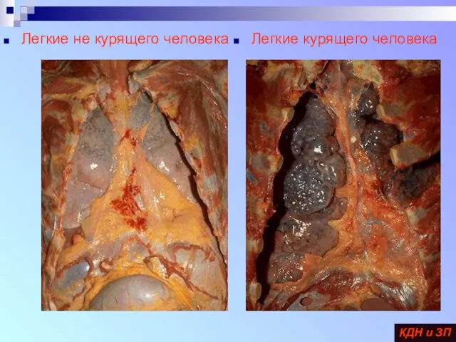 Легкие курящего человека Легкие не курящего человека КДН и ЗП