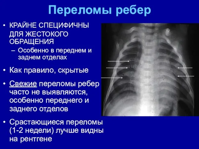 Переломы ребер КРАЙНЕ СПЕЦИФИЧНЫ ДЛЯ ЖЕСТОКОГО ОБРАЩЕНИЯ Особенно в переднем и заднем