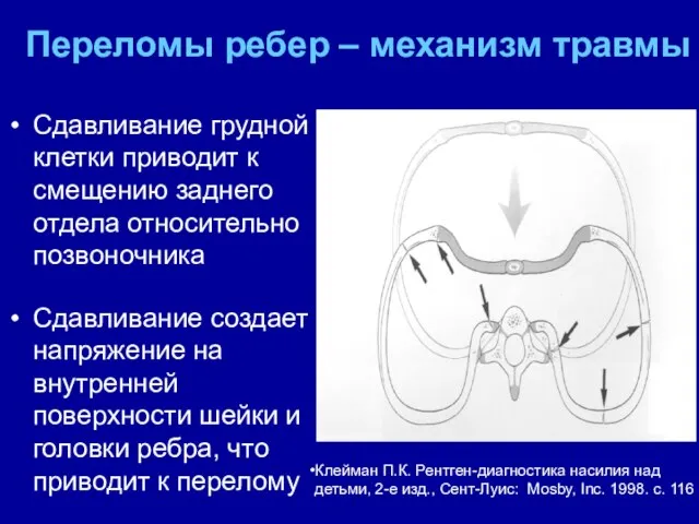 Переломы ребер – механизм травмы Сдавливание грудной клетки приводит к смещению заднего