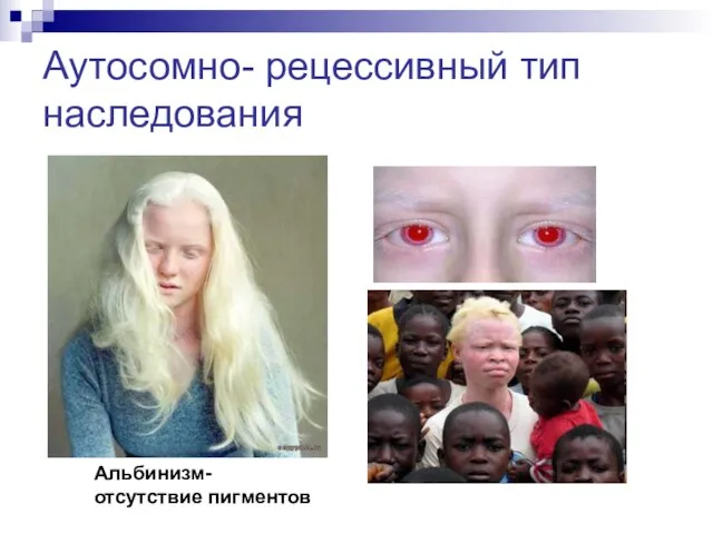Аутосомно- рецессивный тип наследования Альбинизм- отсутствие пигментов