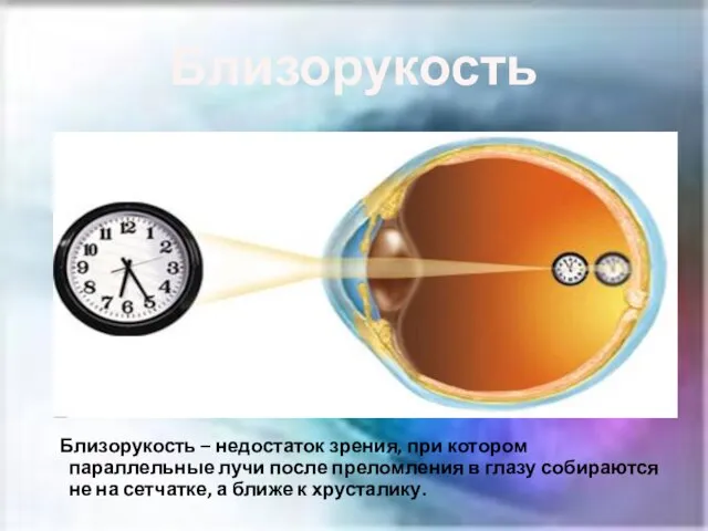 Близорукость Близорукость – недостаток зрения, при котором параллельные лучи после преломления в