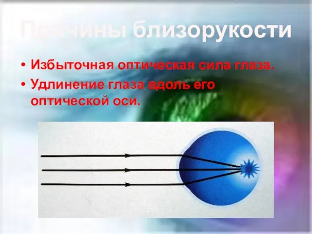 Причины близорукости Избыточная оптическая сила глаза. Удлинение глаза вдоль его оптической оси.