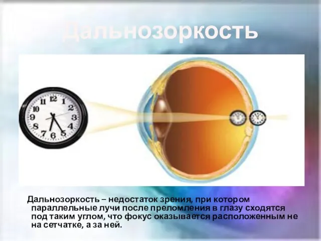 Дальнозоркость Дальнозоркость – недостаток зрения, при котором параллельные лучи после преломления в