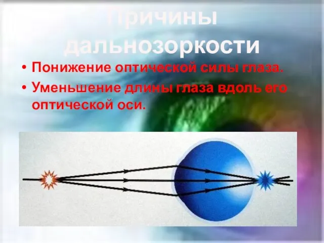 Причины дальнозоркости Понижение оптической силы глаза. Уменьшение длины глаза вдоль его оптической оси.