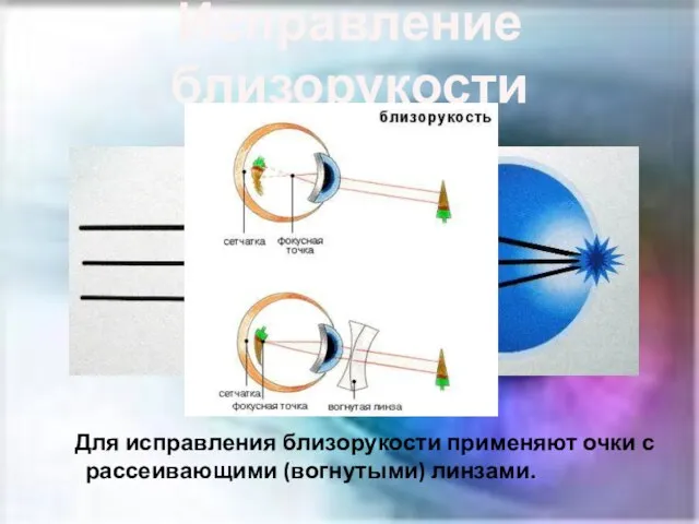 Исправление близорукости Для исправления близорукости применяют очки с рассеивающими (вогнутыми) линзами.