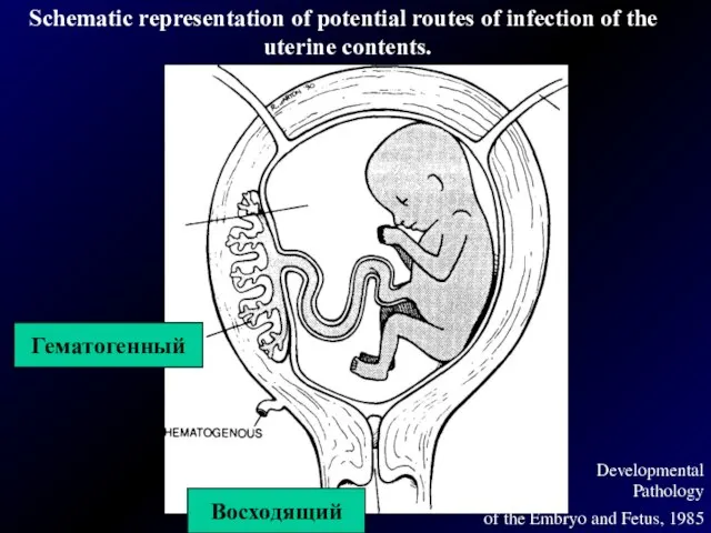 Developmental Pathology of the Embryo and Fetus, 1985 Восходящий Гематогенный