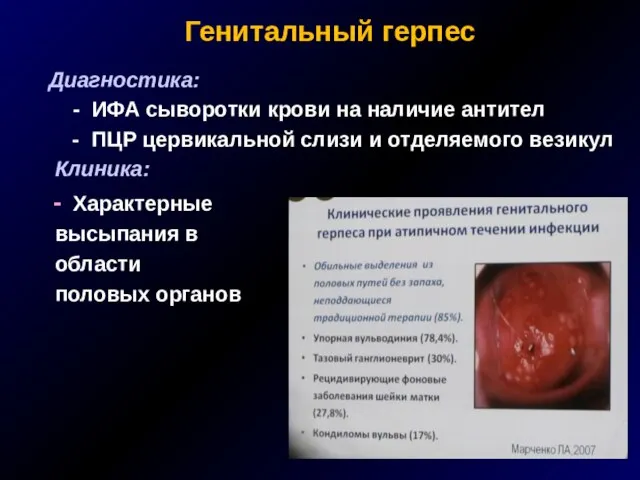 Генитальный герпес Диагностика: - ИФА сыворотки крови на наличие антител - ПЦР