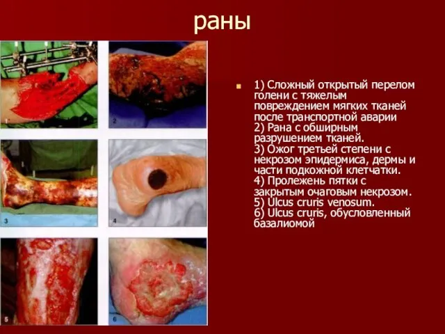 раны 1) Сложный открытый перелом голени с тяжелым повреждением мягких тканей после