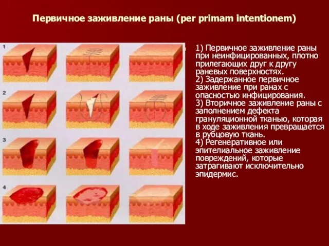 Первичное заживление раны (per primam intentionem) 1) Первичное заживление раны при неинфицированных,