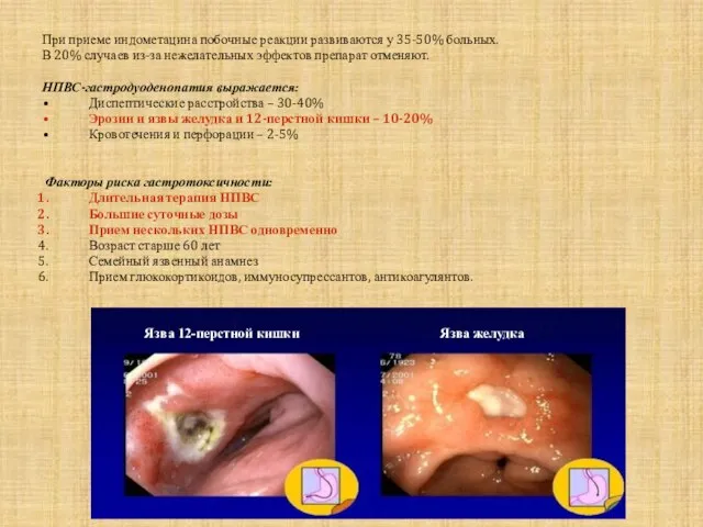 При приеме индометацина побочные реакции развиваются у 35-50% больных. В 20% случаев