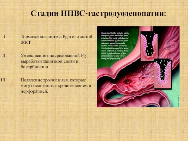 Стадии НПВС-гастродуоденопатии: Торможение синтеза Pg в слизистой ЖКТ Уменьшение опосредованной Pg выработки