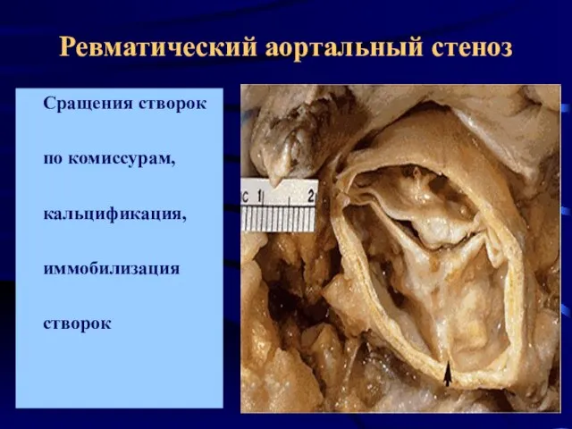 Ревматический аортальный стеноз Сращения створок по комиссурам, кальцификация, иммобилизация створок