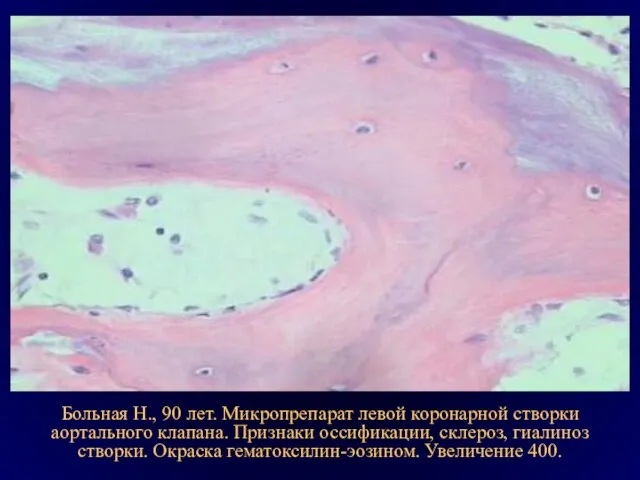 Больная Н., 90 лет. Микропрепарат левой коронарной створки аортального клапана. Признаки оссификации,
