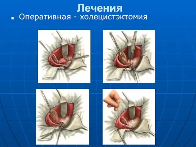 Лечения Оперативная - холецистэктомия