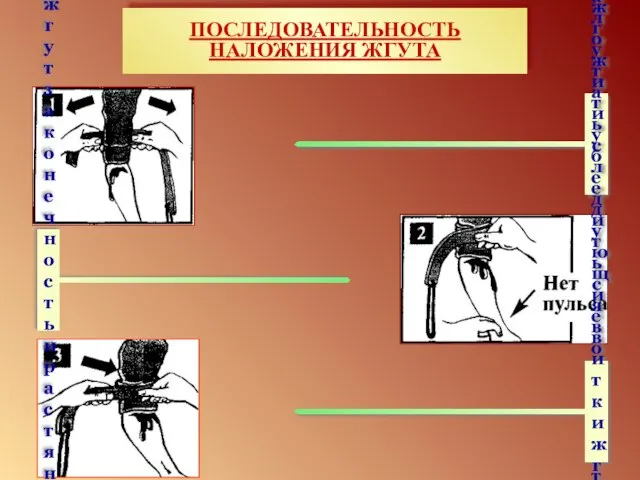 ПОСЛЕДОВАТЕЛЬНОСТЬ НАЛОЖЕНИЯ ЖГУТА Прижать первый виток жгута и убедиться в отсутствии пульса