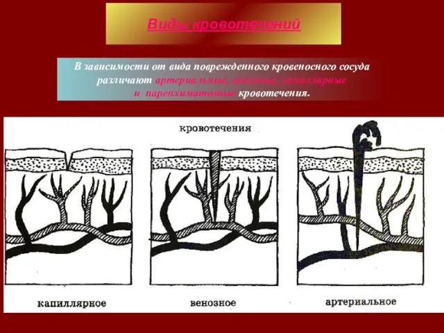 В зависимости от вида поврежденного кровеносного сосуда различают артериальные, венозные, капиллярные и паренхиматозные кровотечения. Виды кровотечений