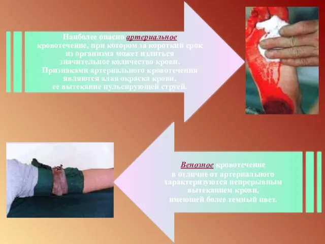 Наиболее опасно артериальное кровотечение, при котором за короткий срок из организма может