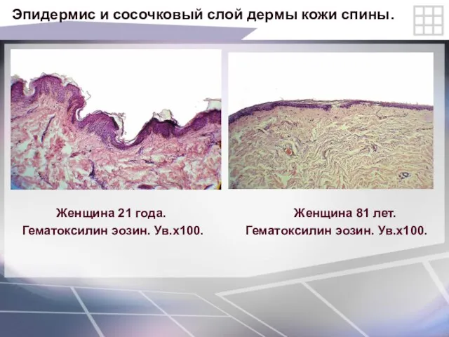 Эпидермис и сосочковый слой дермы кожи спины. Женщина 21 года. Женщина 81