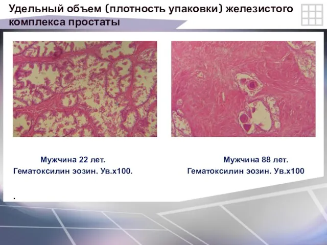 Удельный объем (плотность упаковки) железистого комплекса простаты Мужчина 22 лет. Мужчина 88