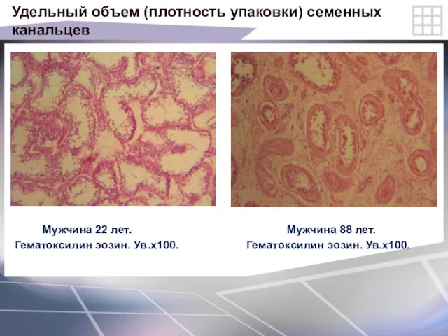 Удельный объем (плотность упаковки) семенных канальцев Мужчина 22 лет. Мужчина 88 лет.