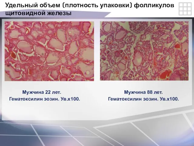 Удельный объем (плотность упаковки) фолликулов щитовидной железы Мужчина 22 лет. Мужчина 88