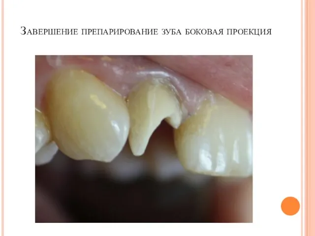 Завершение препарирование зуба боковая проекция