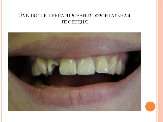 Зуб после препарирования фронтальная проекция