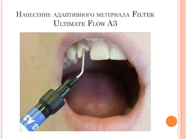 Нанесение адаптивного метериала Filtek Ultimate Flow A3